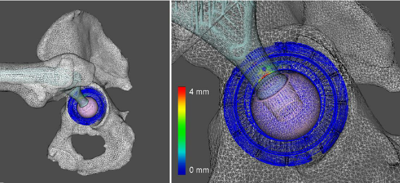 Simulation-of-prosthetic-hip-joint-3D-models-The-color-represents-the-impingement-zone.png